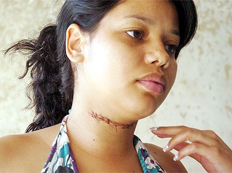 A manicure Esteliane Lima Silva, de 21 anos, teve o pescoço cortado por uma linha de pipa com cerol em 2009 no Jardim Morada do Sol, em Indaiatuba (SP).